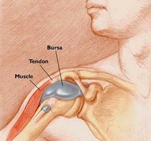 When tendinitis joint hurts directly during exercise
