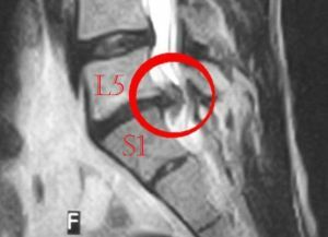 s1 vertebra lumbarisaatio