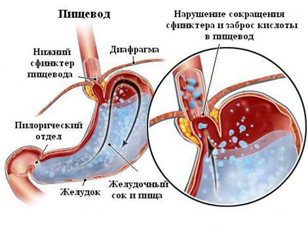 Reflux oesophagitis