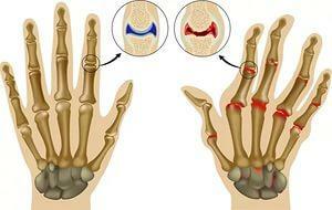 Arthritis on the fingers