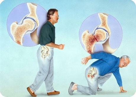 Osteoporozė dažnai sukelia kaulų lūžius