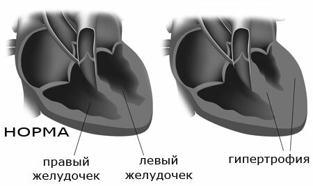 Hypertrophie des linken Ventrikels des Herzens