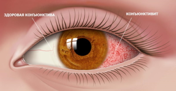 Ocumethyl-Augentropfen. Bewertungen, Gebrauchsanweisung, Preis