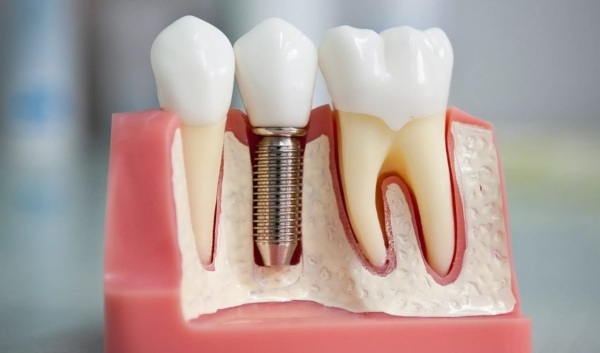 Kako umetnuti implantata zub. Vrste, cijena, ako se, kako je ozlijeđen, recenzije