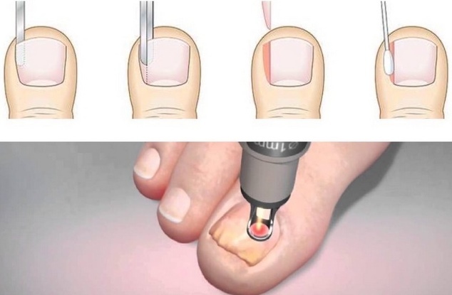 Laserska korekcija noktiju na nogama, noktiju, urasli nokti. Što je to, kako to rade, cijena