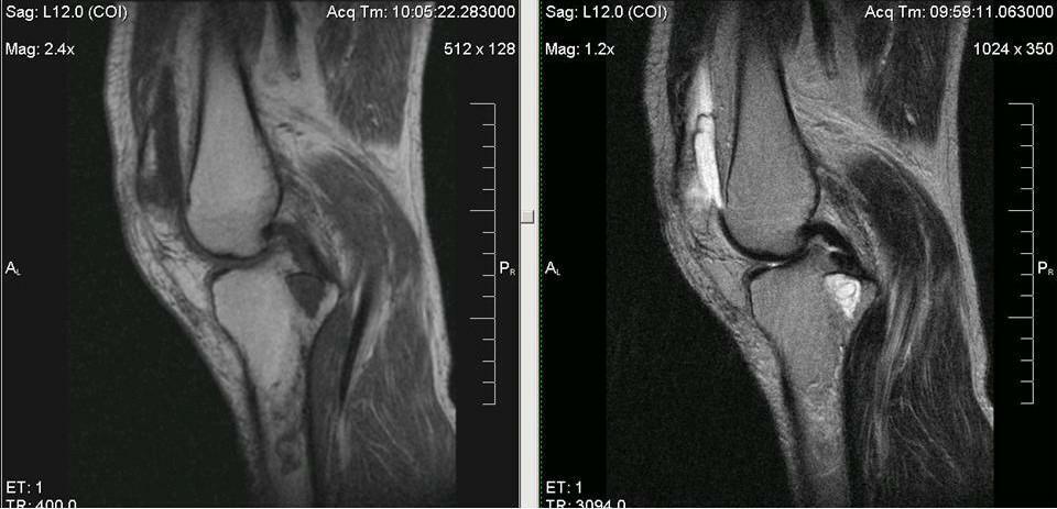 MRI do joelho