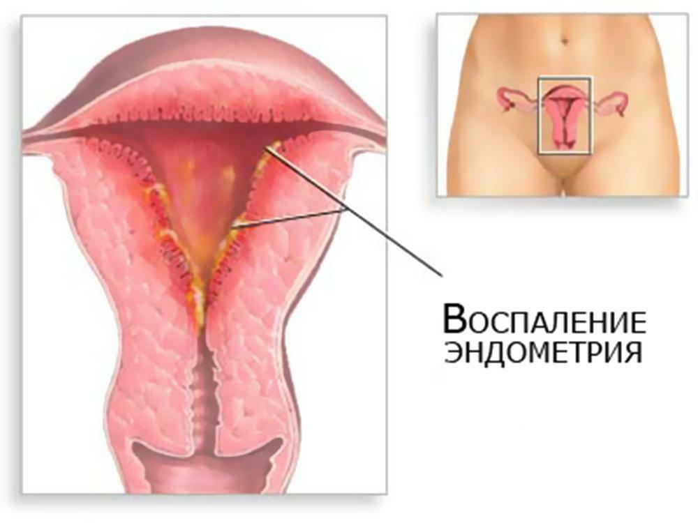 Endometritas