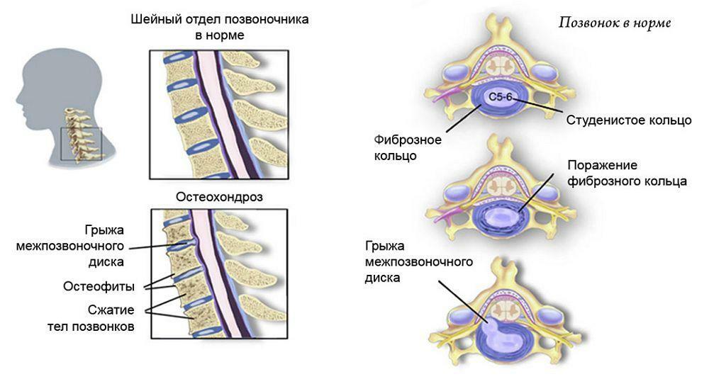 Espina sana y columna vertebral con hernia