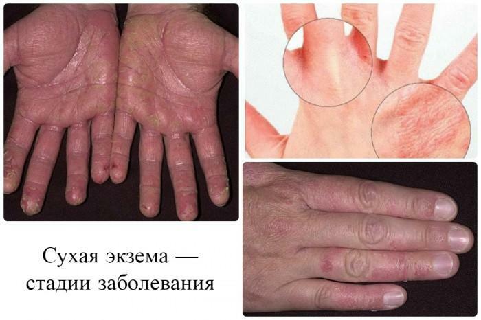 Stages of development of dry eczema