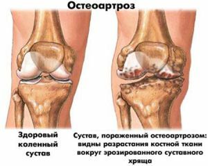 osteoartrite do joelho