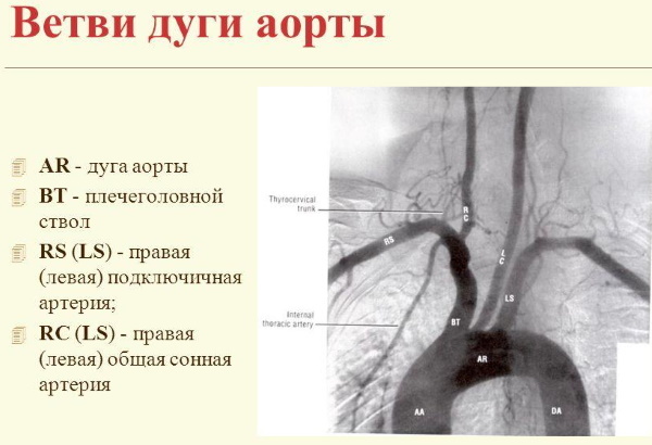 Internal carotid artery. Anatomy, branches, scheme
