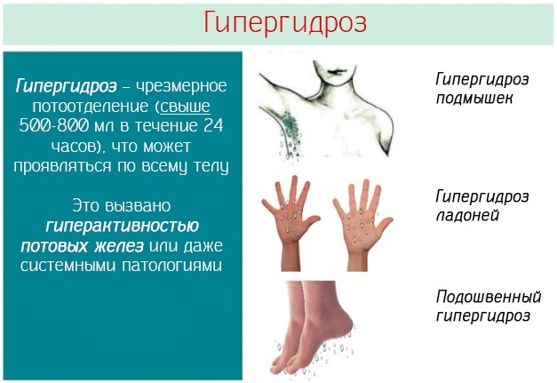 Hyperhidrosis of the palms and feet. Laser treatment, folk remedies