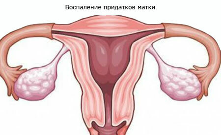 Inflammation of the appendages in women, symptoms and treatment