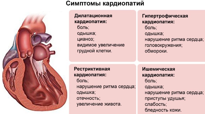 Išsiplėtusi kardiomiopatija. Kas tai yra, simptomai, klinikinės gairės, gydymas suaugusiems, vaikams