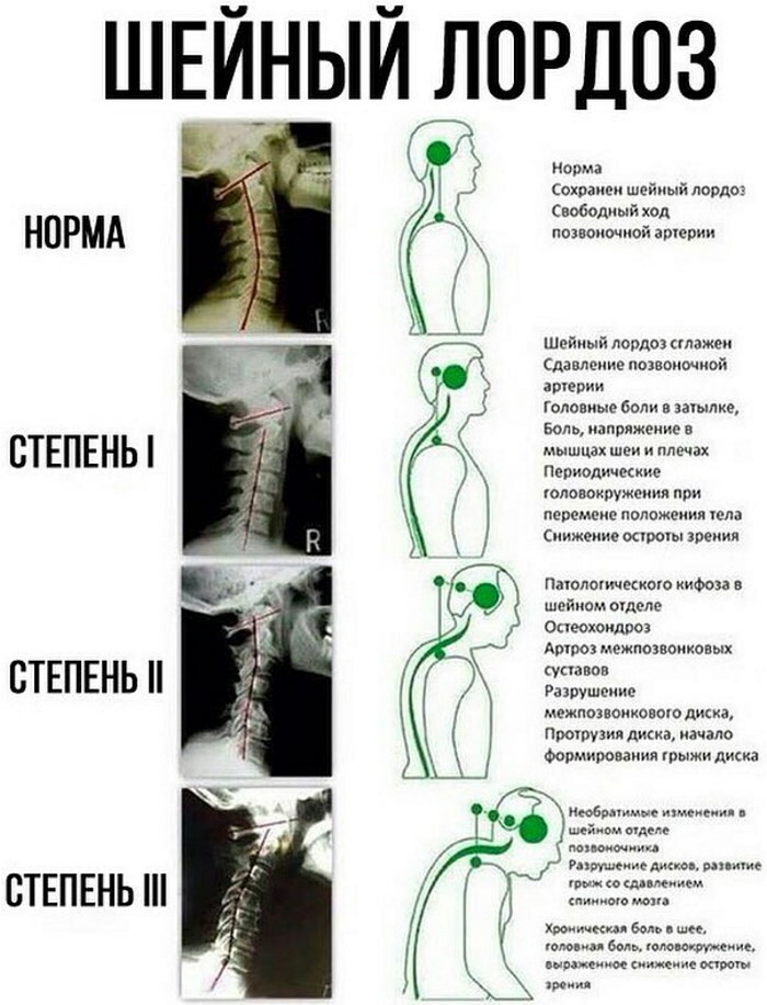 Lordosis dan kyphosis tulang belakang. Apa itu, foto, perawatan, latihan