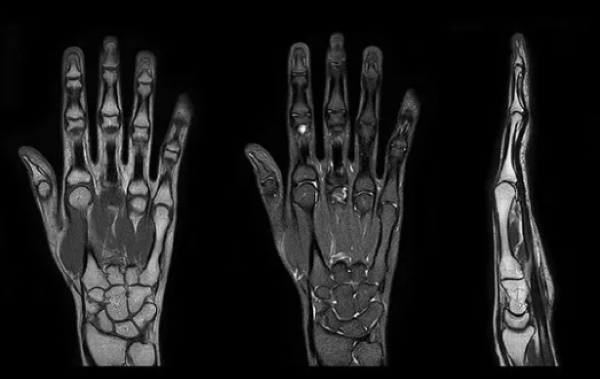 MRI käden. Mikä osoittaa, miten se suoritetaan, hinta, valmistelu