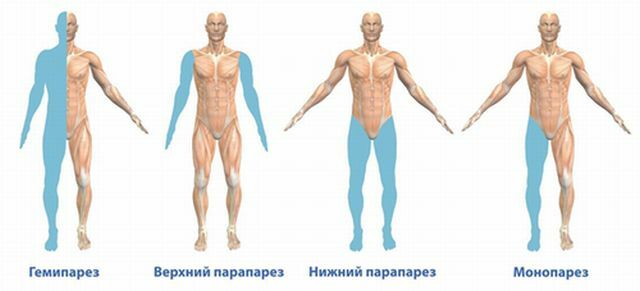 What is paraparesis of the extremities: the causes and treatment
