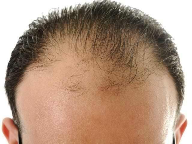 Hair loss in men at a young age