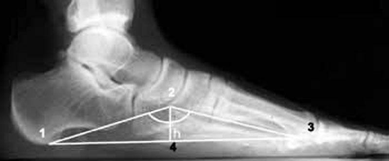 Radiografia este efectuată într-o poziție în picioare sub sarcină.Și își iau ambele picioare