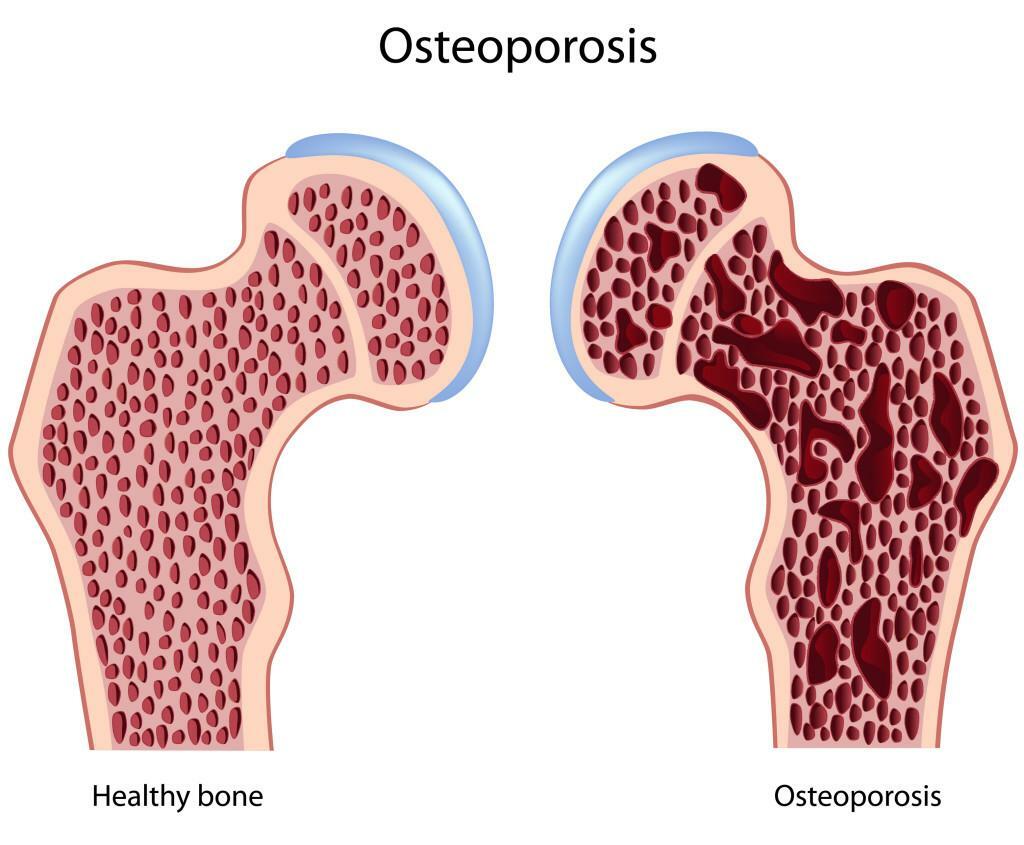 Causes of osteoporosis of bones