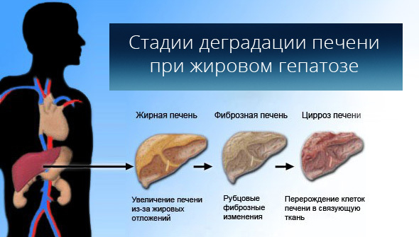 Stages of liver degradation in fatty hepatosis