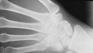 Osteolyse der Hand