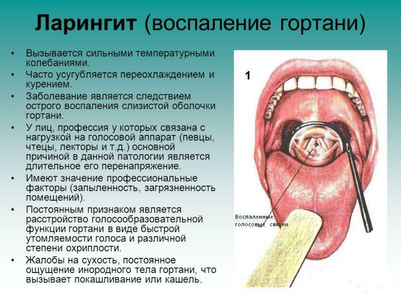 Kas yra laringitas