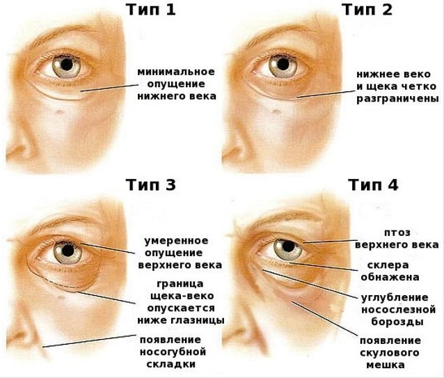 Hernia under the eyes. Causes and treatment in women. Photo, how to get rid of the operation without folk remedies, remove the operation