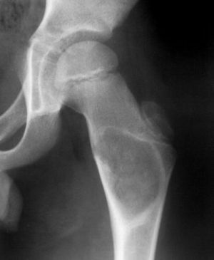 Displasia ósea fibrosa: tratamiento moderno de la patología severa