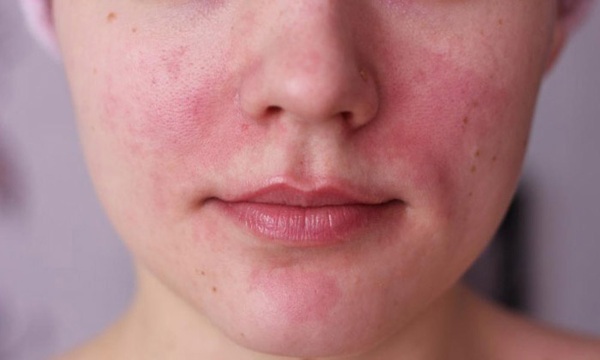 Tør hud under næsen, skrælning, rødme. Årsager, omsorg, behandling