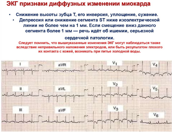 Cicatricial endringer i myokardiet på EKG