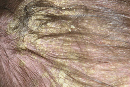 Development of seborrhea on the head, photo 4