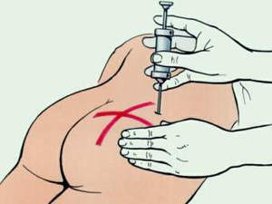 Area of ​​intramuscular injection