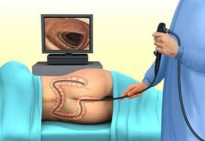 Alternative colonoscopy of the intestines, what does it show?