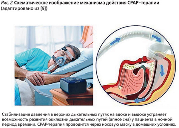 CPAP therapy. What is it, to whom it is shown, reviews