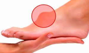 Ce qui caractérise l'hygroma du pied: symptômes et traitement