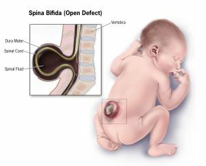 What causes splitting of the spine( Spina bifida)