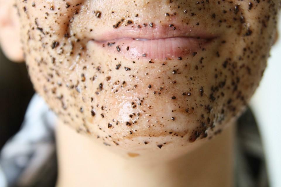 Comment enlever les rougeurs de l'acné rapidement? Apprenez de notre article!