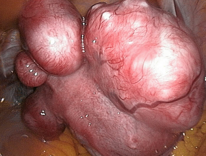 Mama submútil uterino: tratamento, sintomas, causas