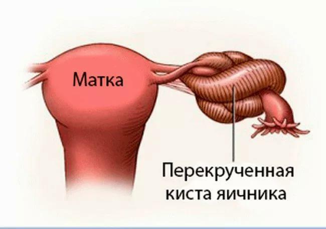 Torsion of leg of ovarian cyst