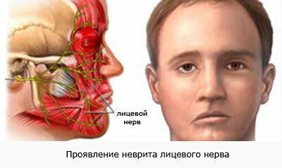 Neuritis obraznega živca
