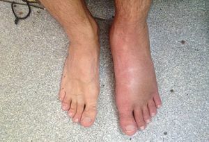 gezwollen voet
