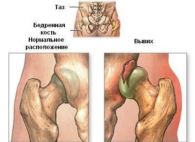 Hip dislocare