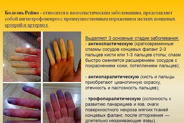 stages of development of Raynaud