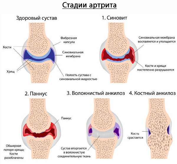 Knee arthritis. Treatment of 1-2 degrees, drugs, ointments