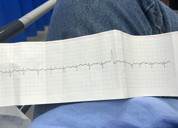 Ventrikulær ekstrasystol på EKG: tegn, dekoding