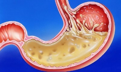 Gastrooesophagealis reflux: tünetek, mi az, kezelés