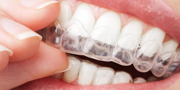 Blanchiment des dents à domicile avec protège-dents. Avis, prix