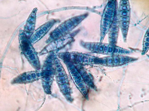 Mikrosporija pri otrocih (versicolor). Fotografija, zdravljenje gladke kože, lasišča, simptomi, inkubacijska doba, karantena