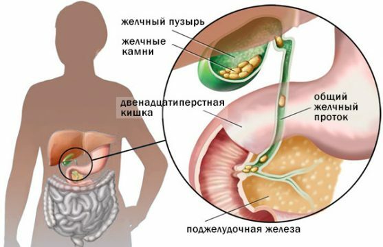Pankreatit ve gastrit için beslenme